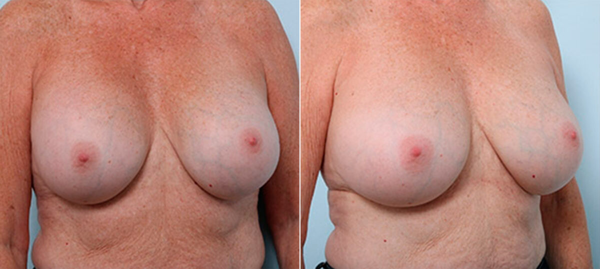 Breast Revision with Strattice before and after photos in Houston, TX, Patient 27235