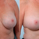 Breast Revision with Strattice before and after photos in Houston, TX, Patient 27235