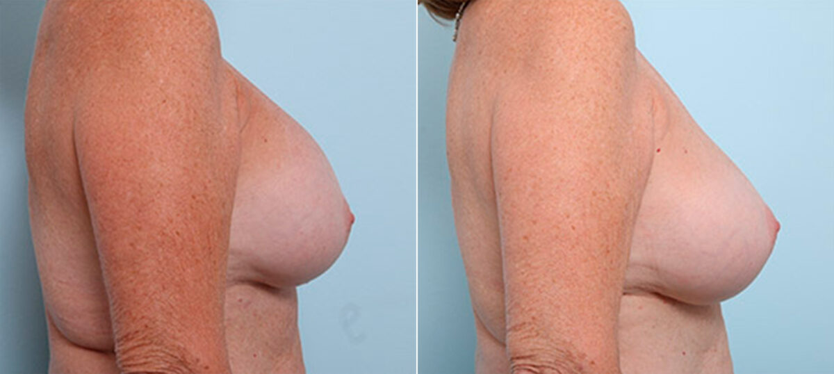 Breast Revision with Strattice before and after photos in Houston, TX, Patient 27235