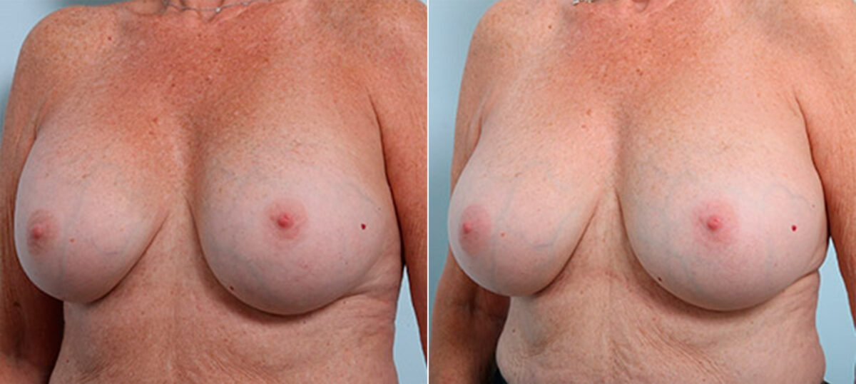 Breast Revision with Strattice before and after photos in Houston, TX, Patient 27235