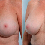 Breast Revision with Strattice before and after photos in Houston, TX, Patient 27235