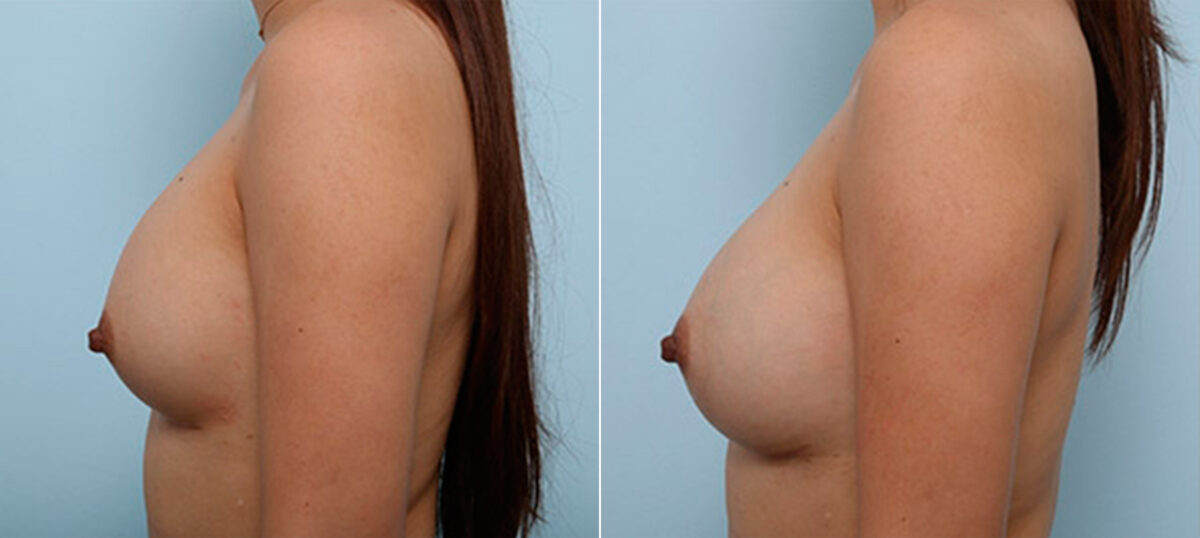 Breast Revision with Strattice before and after photos in Houston, TX, Patient 27246