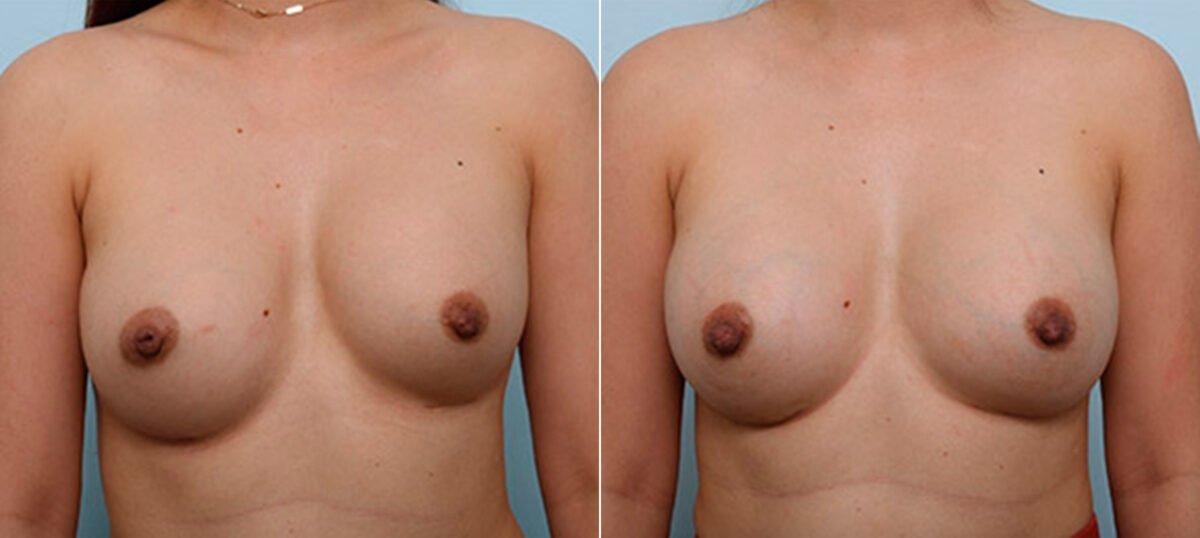 Breast Revision with Strattice before and after photos in Houston, TX, Patient 27246