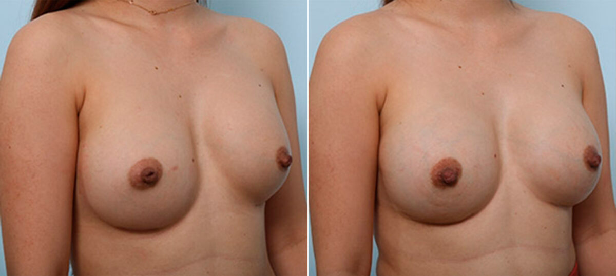 Breast Revision with Strattice before and after photos in Houston, TX, Patient 27246