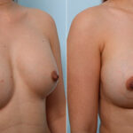 Breast Revision with Strattice before and after photos in Houston, TX, Patient 27246