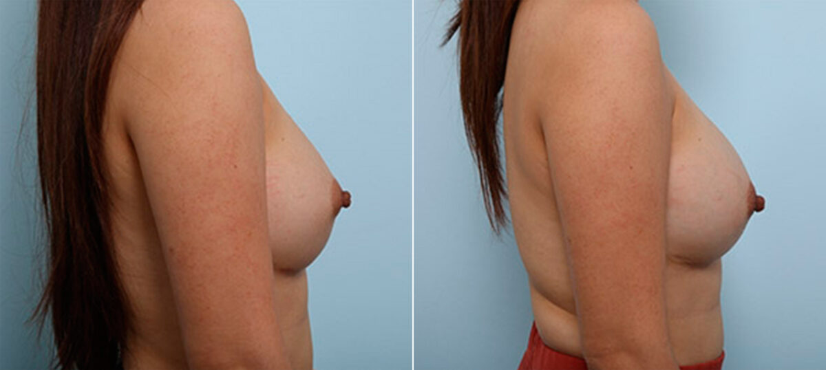 Breast Revision with Strattice before and after photos in Houston, TX, Patient 27246