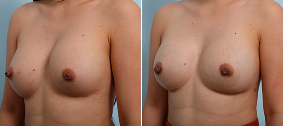 Breast Revision with Strattice before and after photos in Houston, TX, Patient 27246