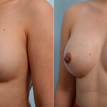 Breast Revision with Strattice before and after photos in Houston, TX, Patient 27246