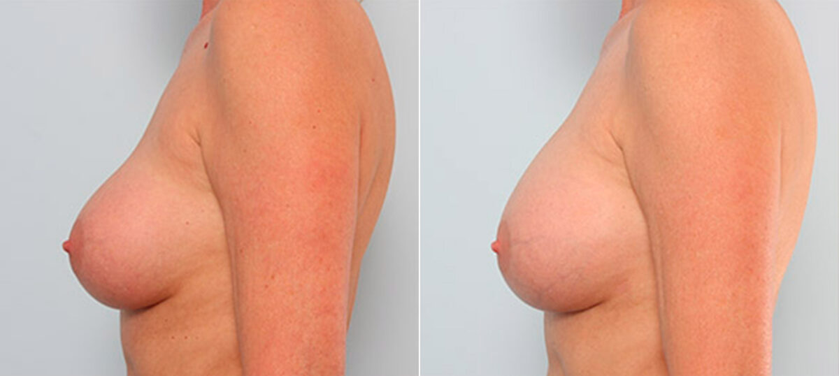 Breast Revision with Strattice before and after photos in Houston, TX, Patient 27257