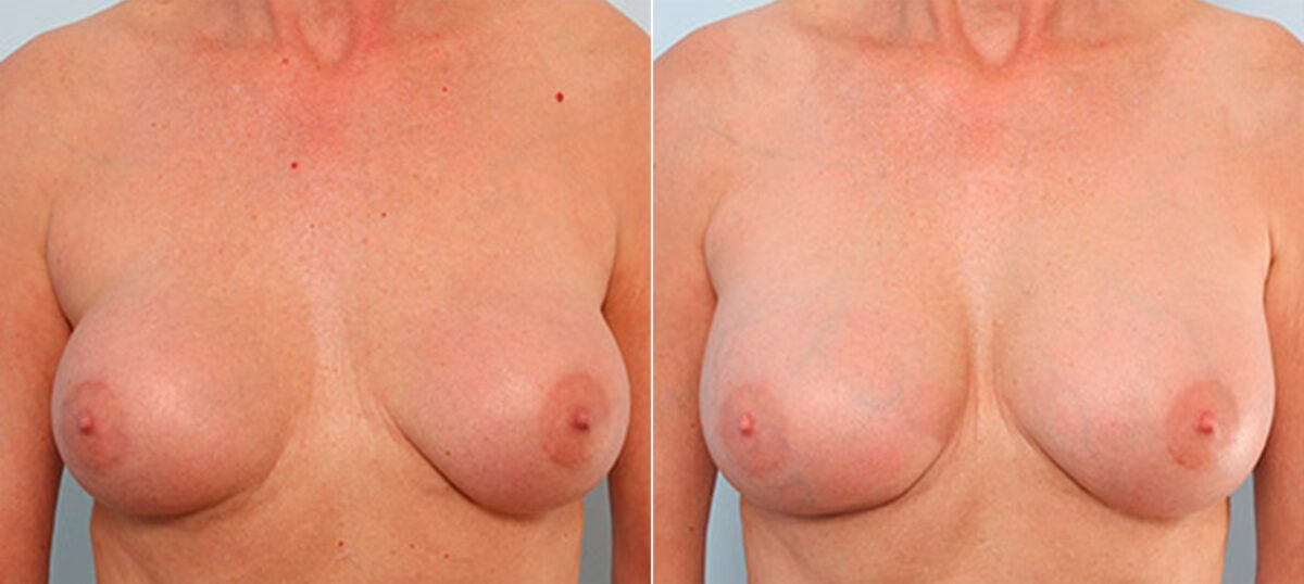 Breast Revision with Strattice before and after photos in Houston, TX, Patient 27257