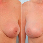 Breast Revision with Strattice before and after photos in Houston, TX, Patient 27257