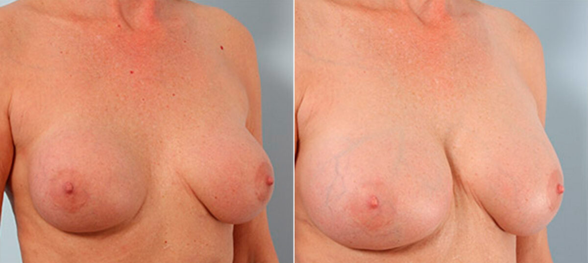 Breast Revision with Strattice before and after photos in Houston, TX, Patient 27257