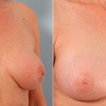 Breast Revision with Strattice before and after photos in Houston, TX, Patient 27257