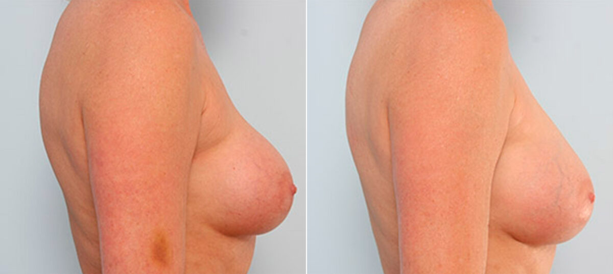 Breast Revision with Strattice before and after photos in Houston, TX, Patient 27257