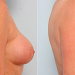 Breast Revision with Strattice before and after photos in Houston, TX, Patient 27257