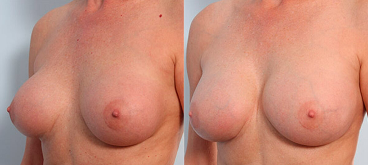 Breast Revision with Strattice before and after photos in Houston, TX, Patient 27257