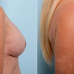 Breast Revision with Strattice before and after photos in Houston, TX, Patient 27268