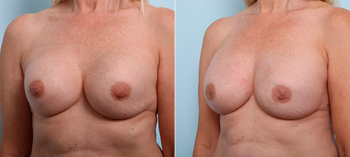 Breast Revision with Strattice before and after photos in Houston, TX, Patient 27268