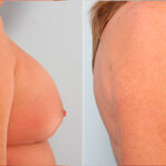 Breast Revision with Strattice before and after photos in Houston, TX, Patient 27279