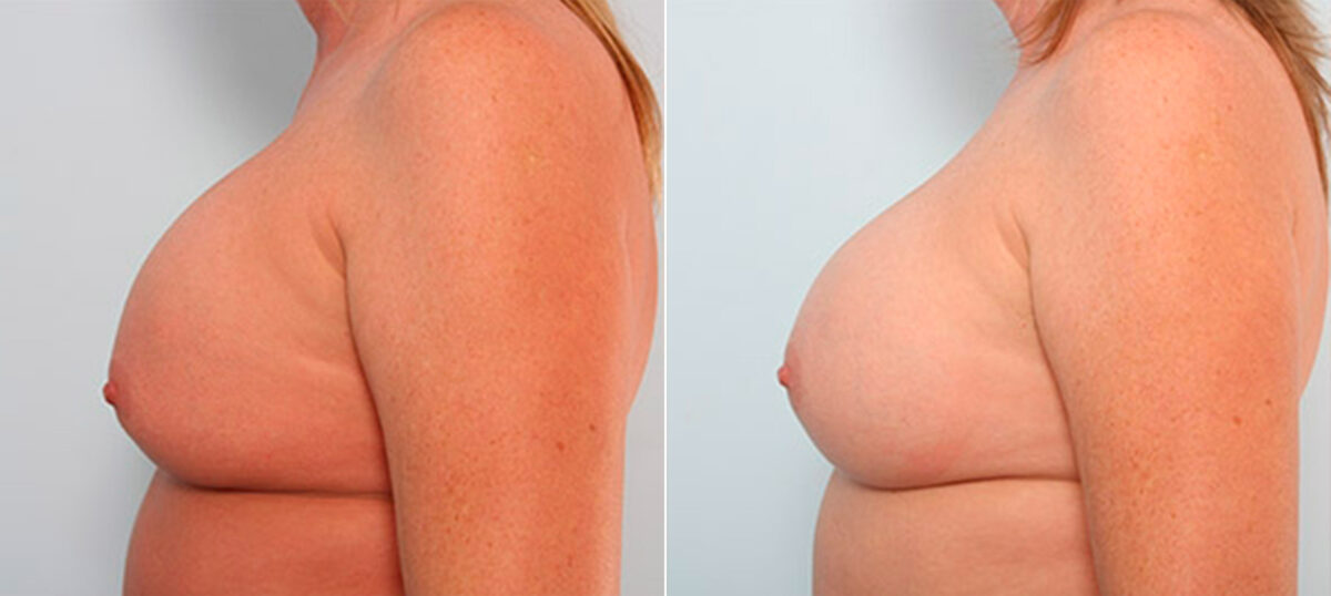 Breast Revision with Strattice before and after photos in Houston, TX, Patient 27279