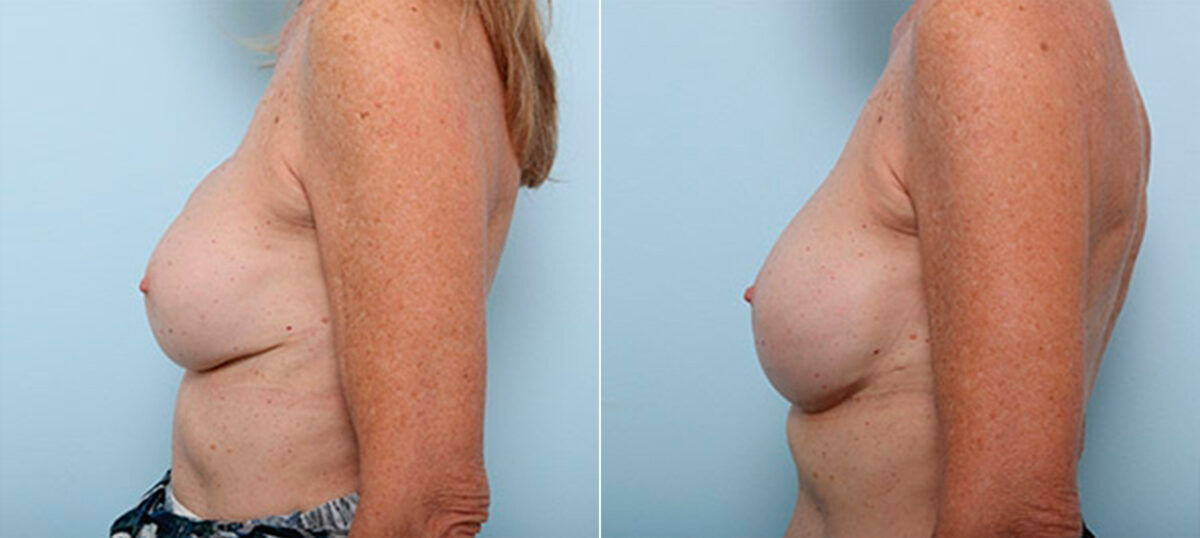 Breast Revision with Strattice before and after photos in Houston, TX, Patient 27290