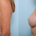 Breast Revision with Strattice before and after photos in Houston, TX, Patient 27290