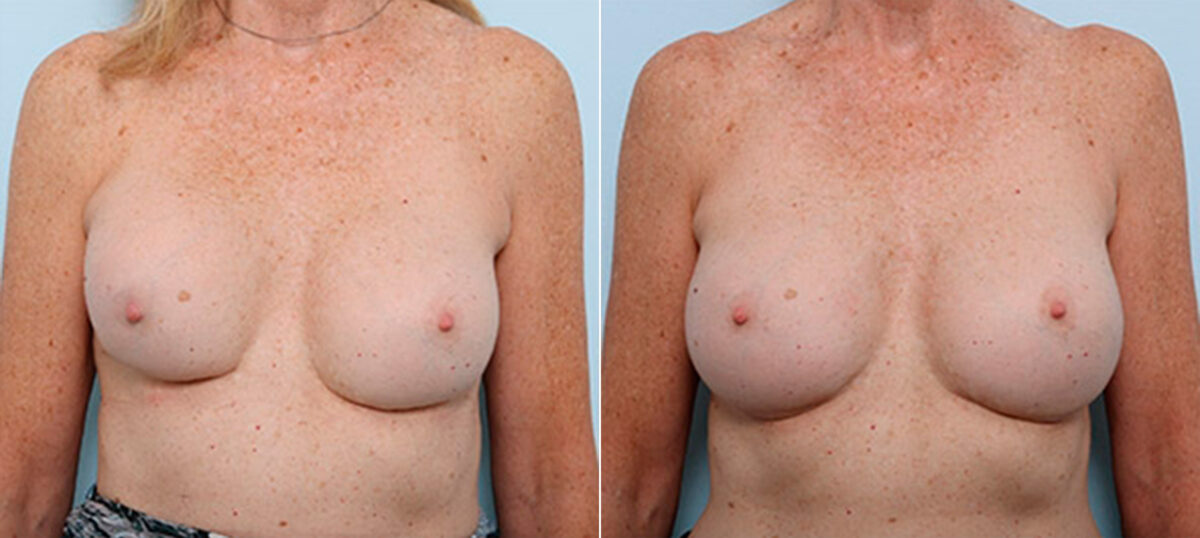 Breast Revision with Strattice before and after photos in Houston, TX, Patient 27290