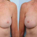 Breast Revision with Strattice before and after photos in Houston, TX, Patient 27290