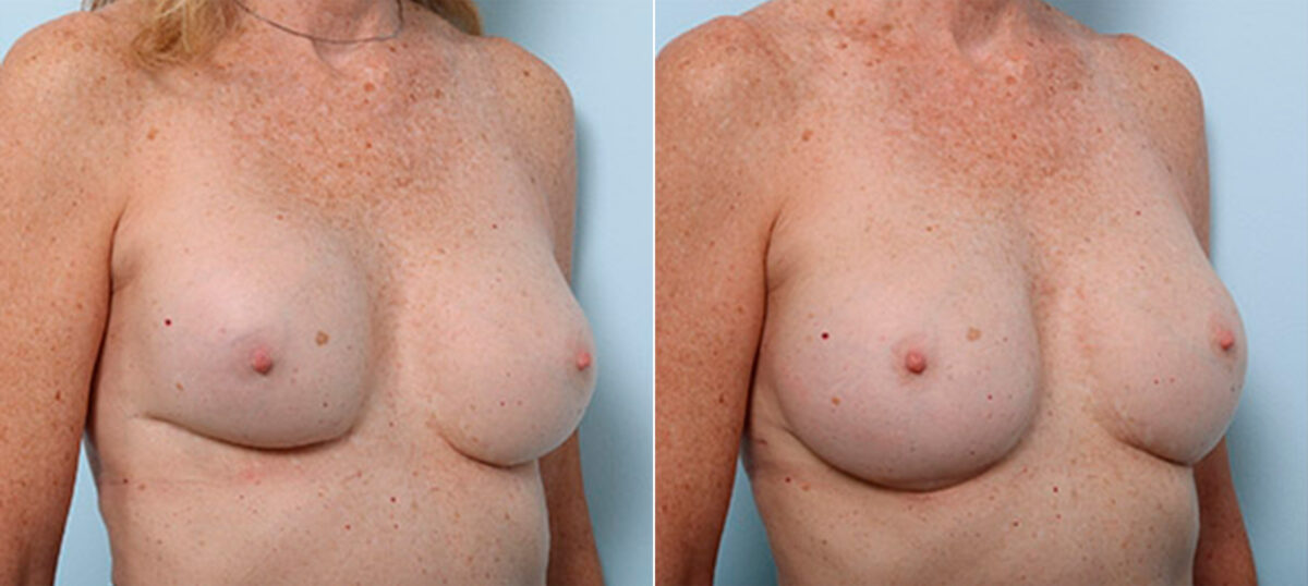 Breast Revision with Strattice before and after photos in Houston, TX, Patient 27290