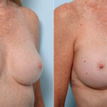 Breast Revision with Strattice before and after photos in Houston, TX, Patient 27290