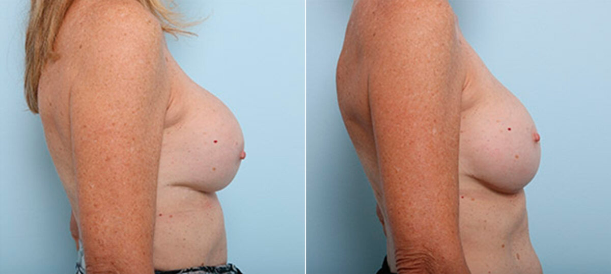 Breast Revision with Strattice before and after photos in Houston, TX, Patient 27290