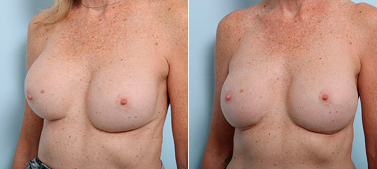 Breast Revision with Strattice before and after photos in Houston, TX, Patient 27290