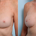 Breast Revision with Strattice before and after photos in Houston, TX, Patient 27290