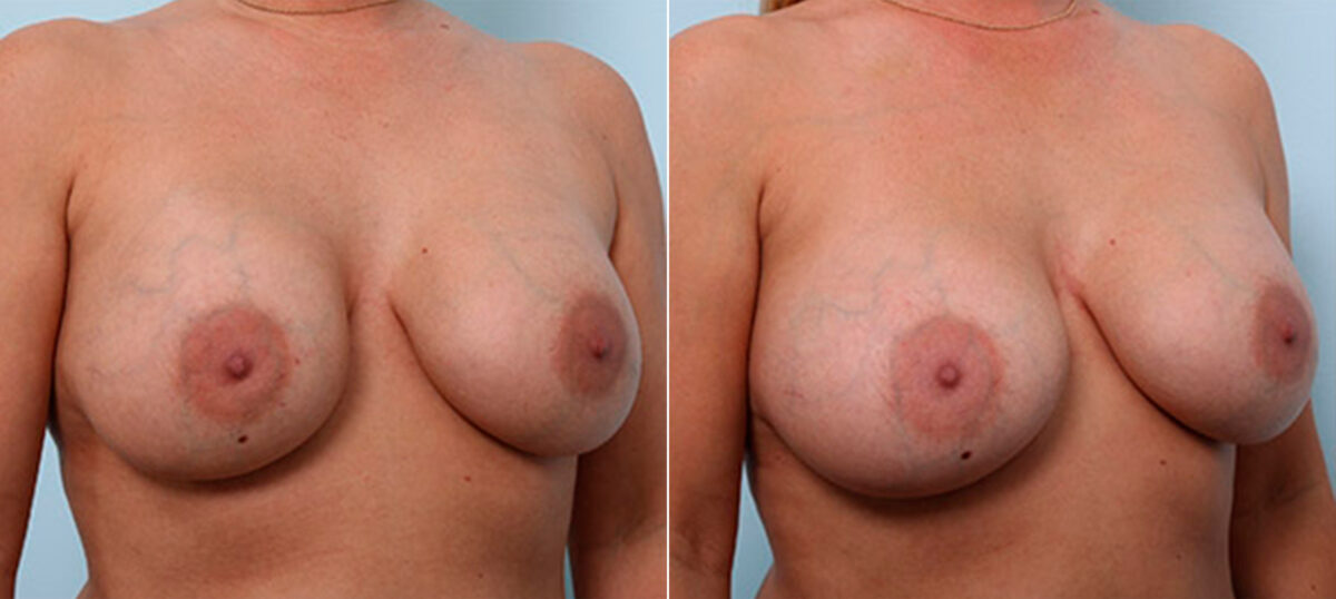 Breast Revision with Strattice before and after photos in Houston, TX, Patient 27301