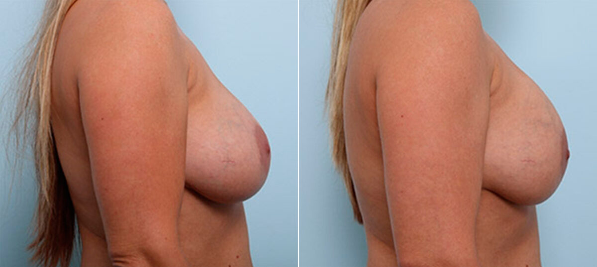 Breast Revision with Strattice before and after photos in Houston, TX, Patient 27301