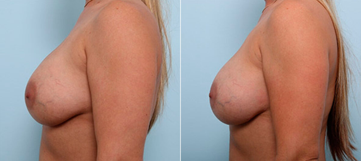 Breast Revision with Strattice before and after photos in Houston, TX, Patient 27301