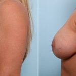 Breast Revision with Strattice before and after photos in Houston, TX, Patient 27301
