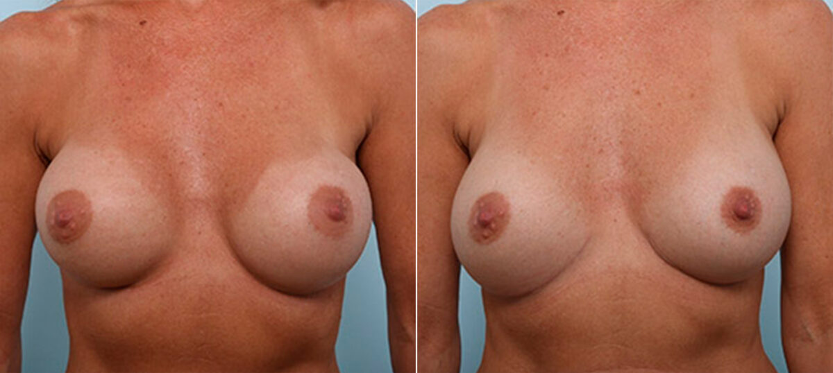 Breast Revision with Strattice before and after photos in Houston, TX, Patient 27312