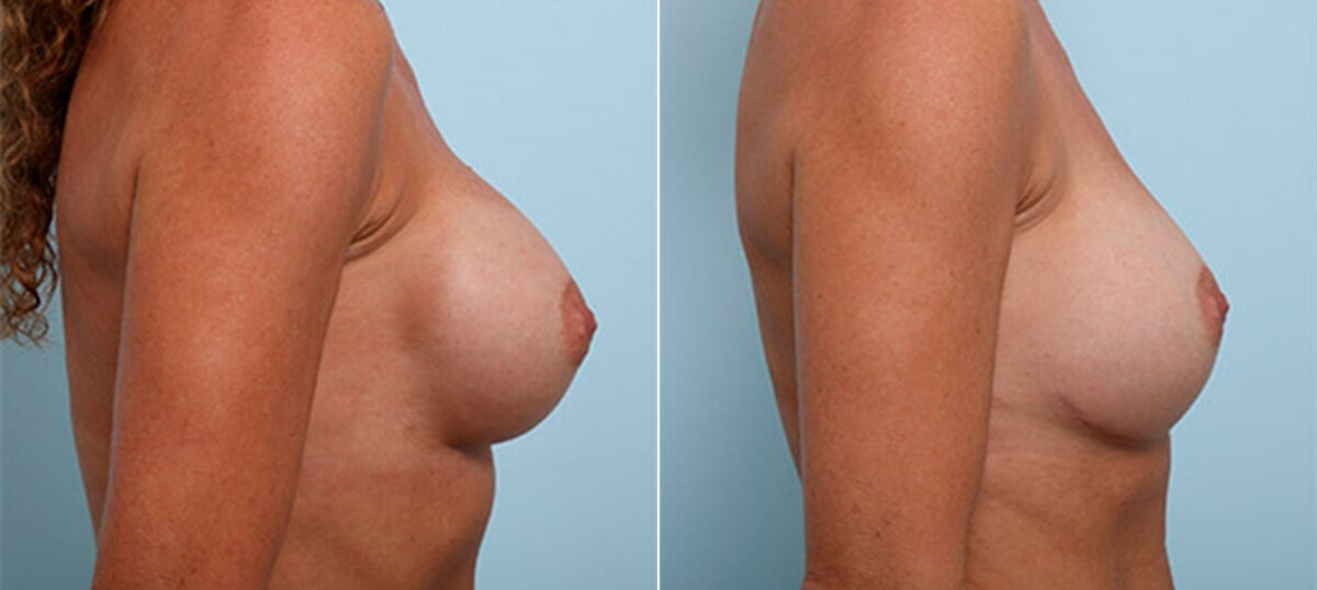Breast Revision with Strattice before and after photos in Houston, TX, Patient 27312