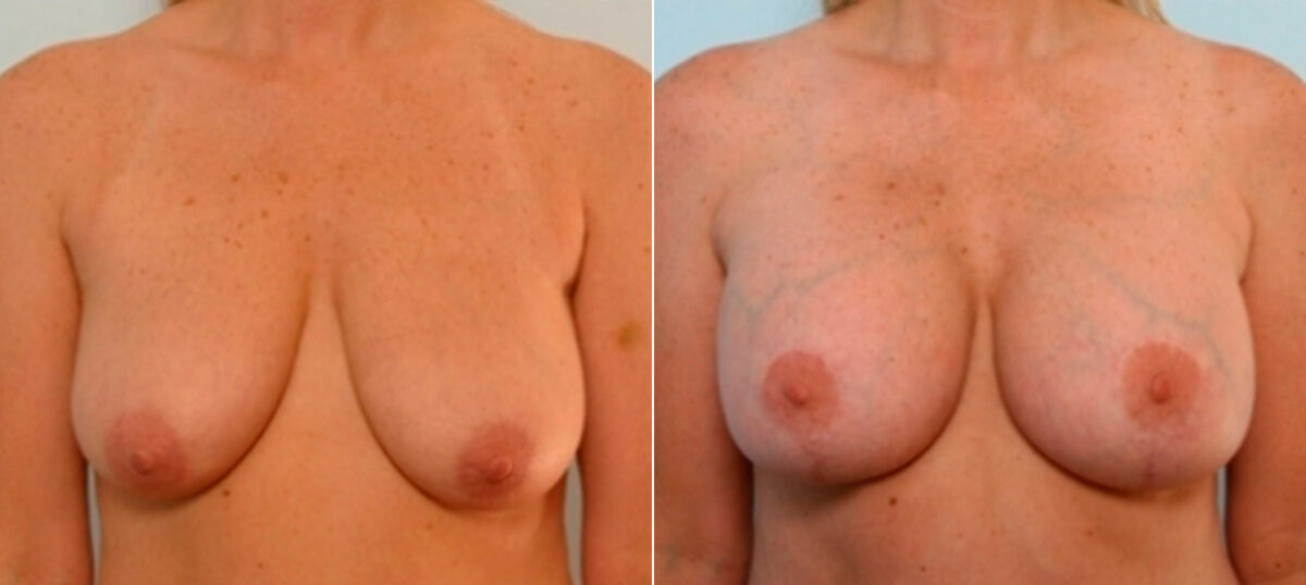 Breast Augmentation-Mastopexy before and after photos in Houston, TX, Patient 27323