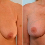 Breast Augmentation-Mastopexy before and after photos in Houston, TX, Patient 27323