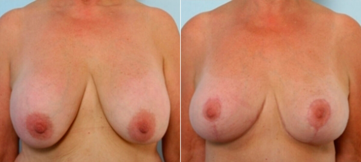 Breast Augmentation-Mastopexy before and after photos in Houston, TX, Patient 27339