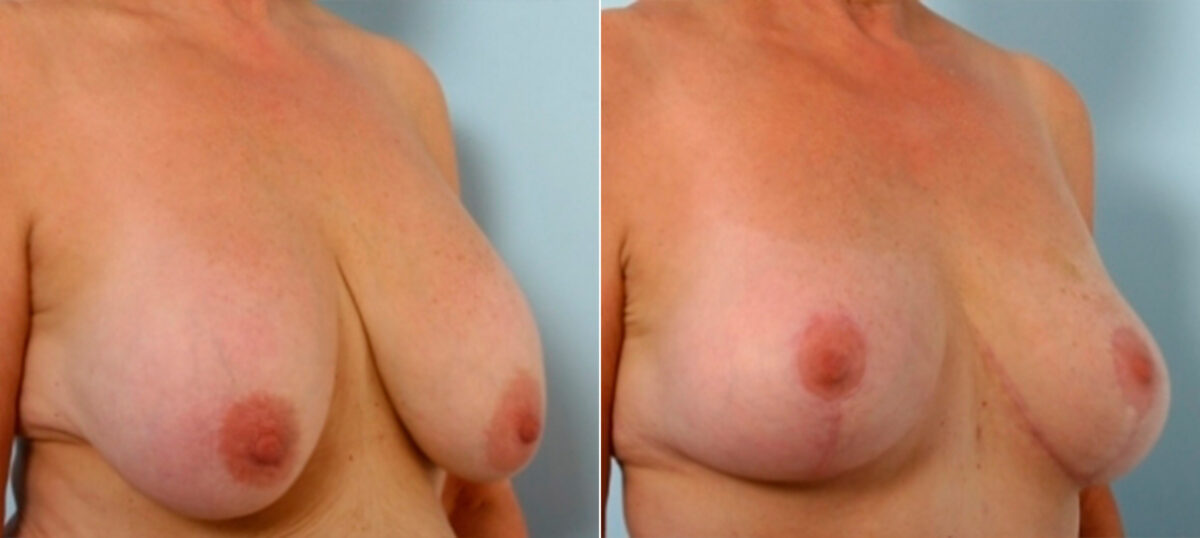 Breast Augmentation-Mastopexy before and after photos in Houston, TX, Patient 27339