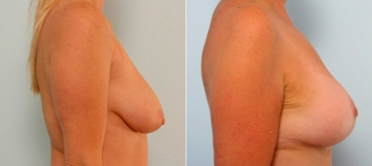 Breast Augmentation-Mastopexy before and after photos in Houston, TX, Patient 27339
