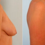 Breast Augmentation-Mastopexy before and after photos in Houston, TX, Patient 27339
