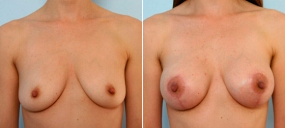 Breast Augmentation-Mastopexy before and after photos in Houston, TX, Patient 27346