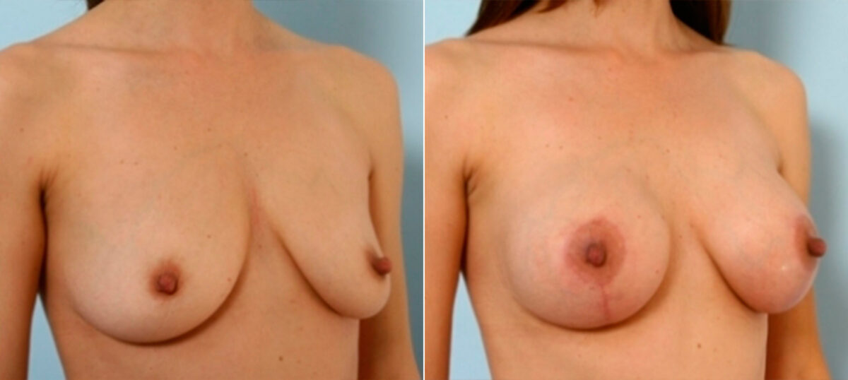 Breast Augmentation-Mastopexy before and after photos in Houston, TX, Patient 27346