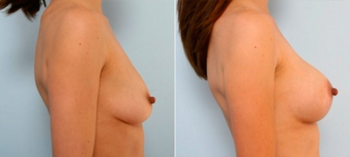 Breast Augmentation-Mastopexy before and after photos in Houston, TX, Patient 27346