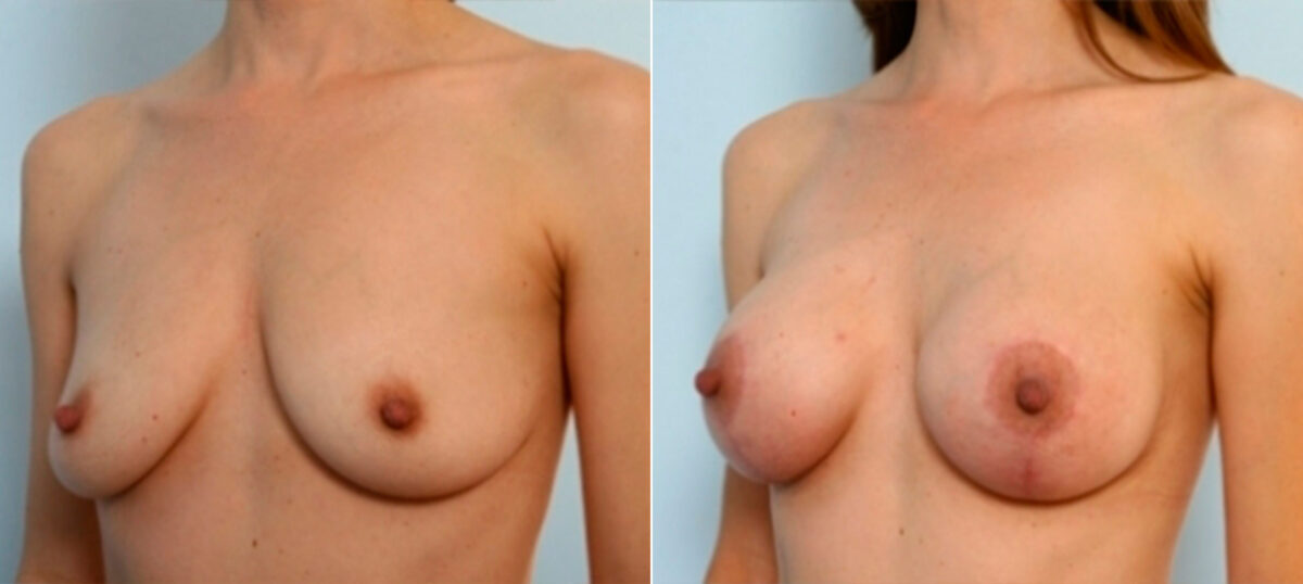 Breast Augmentation-Mastopexy before and after photos in Houston, TX, Patient 27346