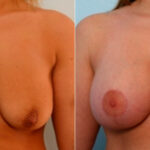 Breast Augmentation-Mastopexy before and after photos in Houston, TX, Patient 27368